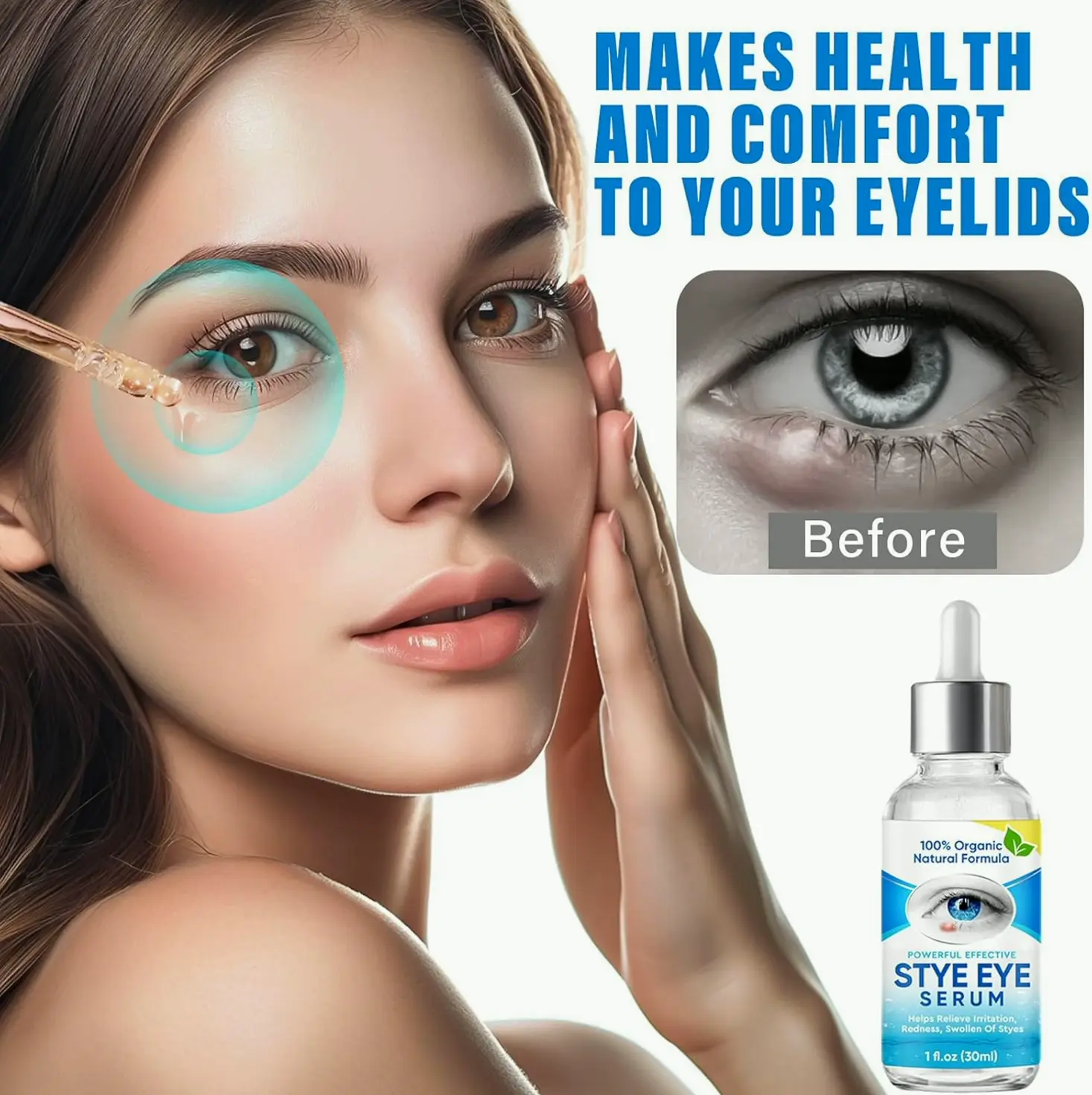 Chalazion Eye Treatment Drops for Fast Efficacy
