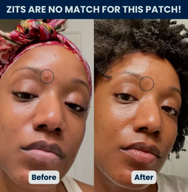 Invisible Pimple Patches - Zit Treatment Sticker