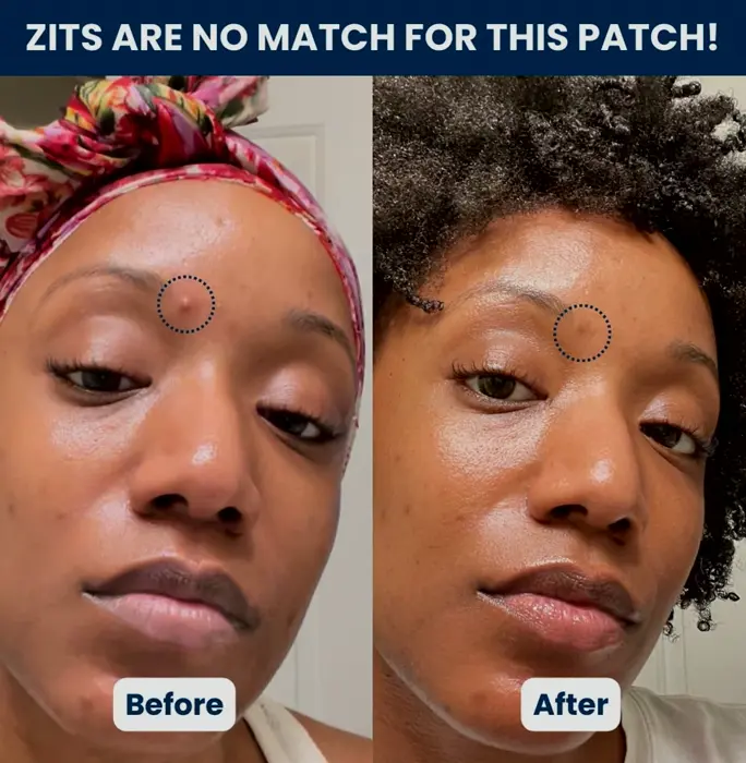 Invisible Pimple Patches - Zit Treatment Sticker