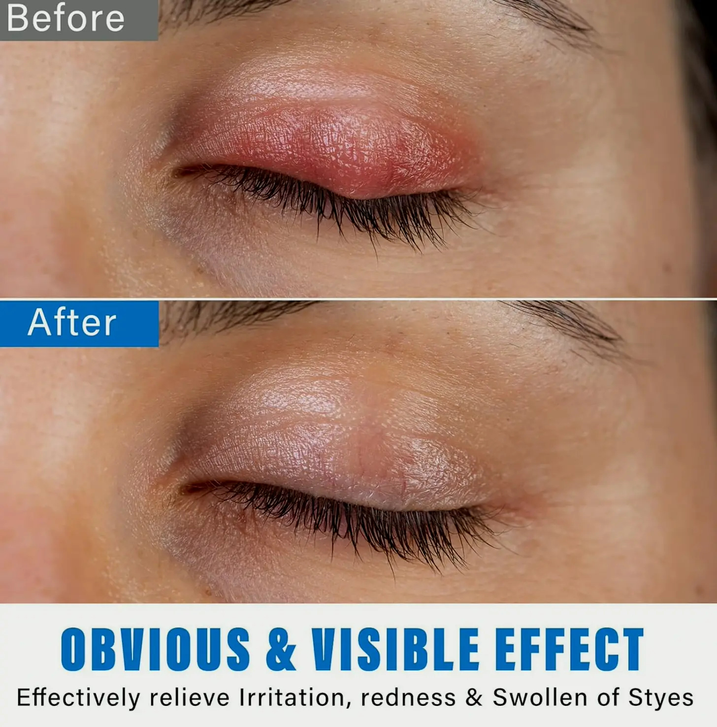 Chalazion Eye Treatment Drops for Fast Efficacy